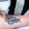 Tattoo removal with neodymium laser