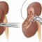 Kidney cancer treatment in Germany